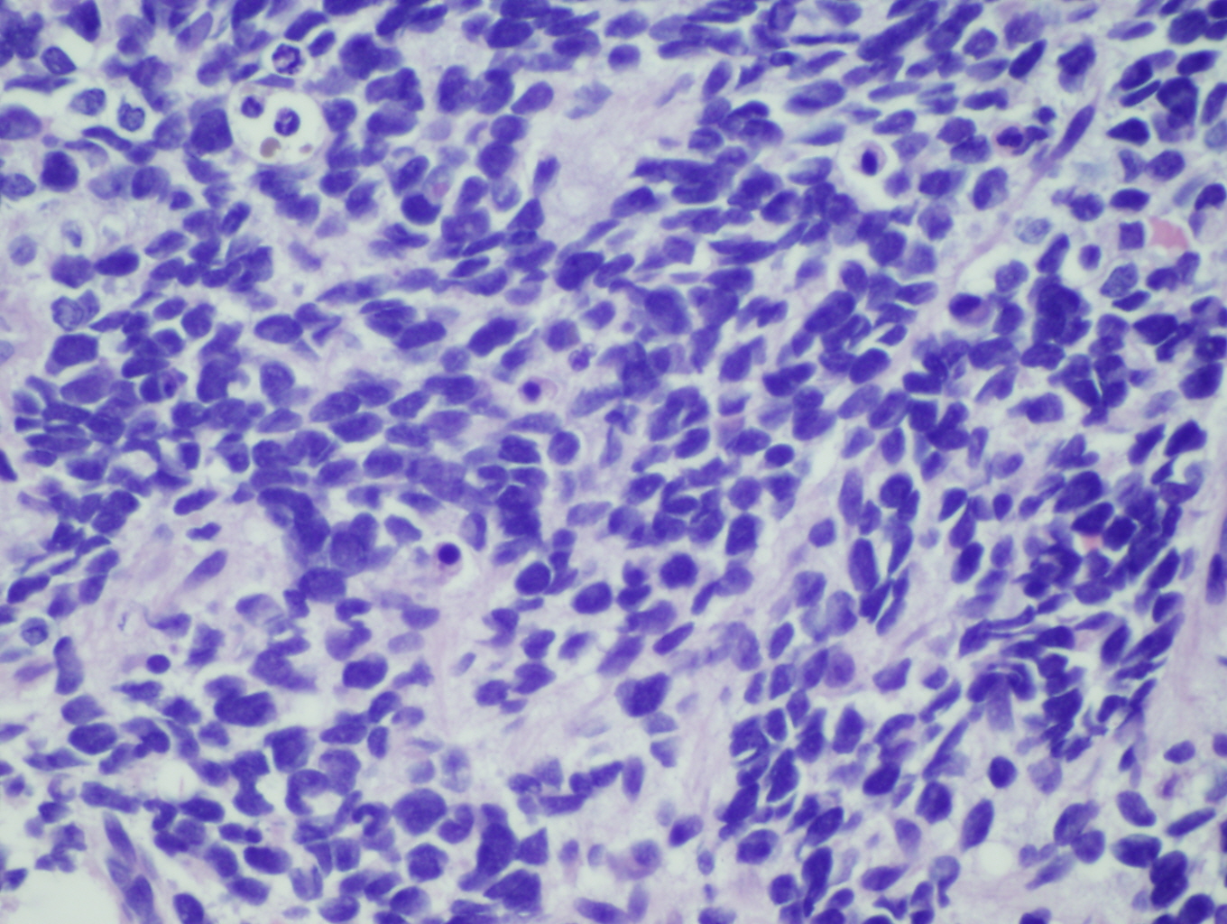 Microscopic image 4 - Biopsy from bone marrow, 60x (Click to enlarge)